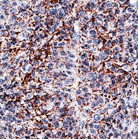 Fibronectin was detected in immersion fixed paraffin-embedded sections of human liver cancer tissue using Mouse Anti-Human Fibronectin Monoclonal Antibody (Catalog # MAB19182) at 5 µg/mL for 1 hour at room temperature followed by incubation with the Anti-Mouse IgG VisUCyte™ HRP Polymer Antibody (Catalog # VC001). Tissue was stained using DAB (brown) and counterstained with hematoxylin (blue). Specific staining was localized to cytoplasm and plasma membrane in tumor cells. View our protocol for IHC Staining with VisUCyte HRP Polymer Detection Reagents.