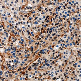 Fibronectin was detected in immersion fixed paraffin-embedded sections of human breast cancer tissue using Mouse Anti-Human Fibronectin Monoclonal Antibody (Catalog # MAB1918) at 15 µg/mL overnight at 4 °C. Tissue was stained using the Anti-Mouse HRP-DAB Cell & Tissue Staining Kit (brown; Catalog # CTS002) and counterstained with hematoxylin (blue). Specific staining was localized to connective tissue and fibroblasts. View our protocol for Chromogenic IHC Staining of Paraffin-embedded Tissue Sections.