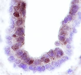 Frk was detected in immersion fixed paraffin-embedded sections of human breast cancer tissue using 15 &micro;g/mL Rat Anti-Human Frk Monoclonal Antibody (Catalog # MAB3766) overnight at 4 &deg;C. Before incubation with the primary antibody tissue was subjected to heat-induced epitope retrieval using Antigen Retrieval Reagent-Basic (Catalog # CTS013). Before incubation with the primary antibody tissue was subjected to heat-induced epitope retrieval using Antigen Retrieval Reagent-Basic (Catalog # CTS013). Tissue was stained with the Anti-Rat HRP-DAB Cell & Tissue Staining Kit (brown; Catalog # CTS017) and counterstained with hematoxylin (blue). Specific labeling was localized to the nucleus of epithelial cells in interlobular ducts. View our protocol for Chromogenic IHC Staining of Paraffin-embedded Tissue Sections.