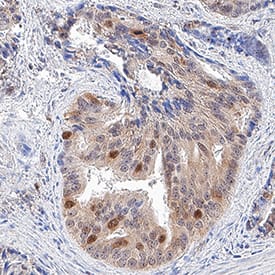 GAPDH was detected in immersion fixed paraffin-embedded sections of human prostate cancer tissue using Goat Anti-Human/Mouse/Rat GAPDH Antigen Affinity-purified Polyclonal Antibody (Catalog # AF5718) at 3 µg/mL for 1 hour at room temperature followed by incubation with the Anti-Goat IgG VisUCyte™ HRP Polymer Antibody (VC004). Tissue was stained using DAB (brown) and counterstained with hematoxylin (blue). Specific staining was localized to cytoplasm and nuclei. View our protocol for IHC Staining with VisUCyte HRP Polymer Detection Reagents.