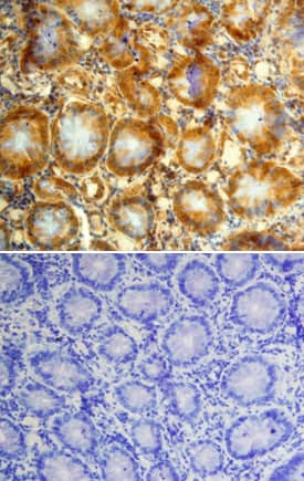GDF-11/BMP-11 was detected in immersion fixed paraffin-embedded sections of human colon cancer tissue using Mouse Anti-Human GDF-11/BMP-11 Monoclonal Antibody (Catalog # MAB19581) at 15 µg/mL overnight at 4 °C. Tissue was stained using the Anti-Mouse HRP-DAB Cell & Tissue Staining Kit (brown; Catalog # CTS002) and counterstained with hematoxylin (blue). Lower panel shows a lack of labeling when primary antibodies are omitted and tissue is stained only with secondary antibody followed by incubation with detection reagents. Specific staining was localized to epithelia of the colon. View our protocol for Chromogenic IHC Staining of Paraffin-embedded Tissue Sections.