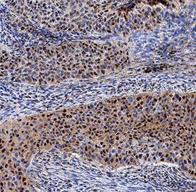 GLI-2 was detected in immersion fixed paraffin-embedded sections of human squamous cell carcinoma using Mouse Anti-Human GLI-2 Monoclonal Antibody (Catalog # MAB35261) at 5 µg/mL for 1 hour at room temperature followed by incubation with the Anti-Mouse IgG VisUCyte™ HRP Polymer Antibody (Catalog # VC001). Tissue was stained using DAB (brown) and counterstained with hematoxylin (blue). Specific staining was localized to nuclei. View our protocol for IHC Staining with VisUCyte HRP Polymer Detection Reagents.