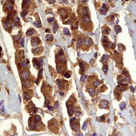 GRB2 was detected in immersion fixed paraffin-embedded sections of human breast cancer tissue using Human GRB2 (SH2 Domain) Monoclonal Antibody (Catalog # MAB38461) at 15 µg/mL overnight at 4 °C. Before incubation with the primary antibody, tissue was subjected to heat-induced epitope retrieval using Antigen Retrieval Reagent-Basic (Catalog # CTS013). Tissue was stained using the Anti-Mouse HRP-DAB Cell & Tissue Staining Kit (brown; Catalog # CTS002) and counterstained with hematoxylin (blue). Specific staining was localized to stromal and epithelial cells. View our protocol for Chromogenic IHC Staining of Paraffin-embedded Tissue Sections.