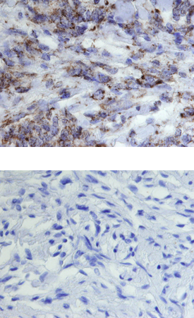 GRP75/HSPA9B was detected in immersion fixed paraffin-embedded sections of human meningioma using 15 µg/mL Goat Anti-Human/Mouse/Rat GRP75/HSPA9B Antigen Affinity-purified Polyclonal Antibody (Catalog # AF3584) overnight at 4 °C. Tissue was stained with the Anti-Goat HRP-DAB Cell & Tissue Staining Kit (brown; Catalog # CTS008) and counterstained with hematoxylin (blue). Lower panel shows a lack of labeling if primary antibodies are omitted and tissue is stained only with secondary antibody followed by incubation with detection reagents. View our protocol for Chromogenic IHC Staining of Paraffin-embedded Tissue Sections.