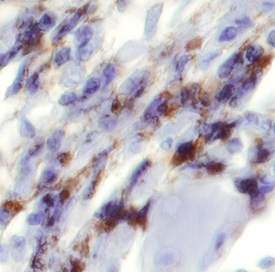 GRP75/HSPA9B was detected in immersion fixed paraffin-embedded sections of human fibroblast menangioma using 25 µg/mL Mouse Anti-Human GRP75/HSPA9B Monoclonal Antibody (Catalog # MAB35841) overnight at 4 °C. Tissue was stained with the Anti-Mouse HRP-DAB Cell & Tissue Staining Kit (brown; Catalog # CTS002) and counterstained with hematoxylin (blue). View our protocol for Chromogenic IHC Staining of Paraffin-embedded Tissue Sections.