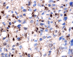 Galectin-1 was detected in immersion fixed paraffin-embedded sections of human prostate cancer tissue using 1.7 µg/mL Goat Anti-Human Galectin-1 Antigen Affinity-purified Polyclonal Antibody (Catalog # AF1152) overnight at 4 °C. Tissue was stained with the Anti-Goat HRP-DAB Cell & Tissue Staining Kit (brown; CTS008) and counterstained with hematoxylin (blue). View our protocol for Chromogenic IHC Staining of Paraffin-embedded Tissue Sections.
