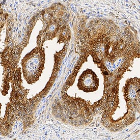 Galectin-3 was detected in immersion fixed paraffin-embedded sections of human prostate cancer tissue using Mouse Anti-Human Galectin-3 Monoclonal Antibody (Catalog # MAB11541) at 1.7 µg/mL for 1 hour at room temperature followed by incubation with the Anti-Mouse IgG VisUCyte™ HRP Polymer Antibody (Catalog # VC001). Tissue was stained using DAB (brown) and counterstained with hematoxylin (blue). Specific staining was localized to cytoplasm and plasma membrane in epithelial cells. View our protocol for IHC Staining with VisUCyte HRP Polymer Detection Reagents.