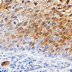 Galectin-7 was detected in immersion fixed paraffin-embedded sections of human cervical cancer tissue using Mouse Anti-Human Galectin-7 Monoclonal Antibody (Catalog # MAB13391) at 5 µg/mL overnight at 4 °C. Tissue was stained using the Anti-Mouse HRP-DAB Cell & Tissue Staining Kit (brown; Catalog # CTS002) and counterstained with hematoxylin (blue). Specific staining was localized to cytoplasm and nuclei. View our protocol for Chromogenic IHC Staining of Paraffin-embedded Tissue Sections.