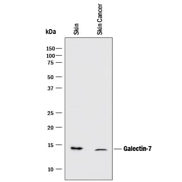 Western blot shows lysates of human skin tissue and human skin cancer tissue. PVDF membrane was probed with 2 µg/mL of Mouse Anti-Human Galectin-7 Monoclonal Antibody (Catalog # MAB13391) followed by HRP-conjugated Anti-Mouse IgG Secondary Antibody (Catalog # HAF018). A specific band was detected for Galectin-7 at approximately 14 kDa (as indicated). This experiment was conducted under reducing conditions and using Immunoblot Buffer Group 1.