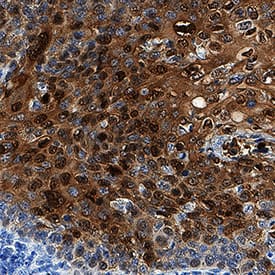 Galectin-7 was detected in immersion fixed paraffin-embedded sections of human cervical cancer tissue using Mouse Anti-Human Galectin-7 Monoclonal Antibody (Catalog # MAB13392) at 5 µg/mL for 1 hour at room temperature followed by incubation with the Anti-Mouse IgG VisUCyte™ HRP Polymer Antibody (Catalog # VC001). Tissue was stained using DAB (brown) and counterstained with hematoxylin (blue). Specific staining was localized to cytoplasm and nuclei. View our protocol for IHC Staining with VisUCyte HRP Polymer Detection Reagents.