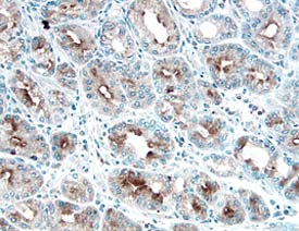 Gas6 was detected in immersion fixed paraffin-embedded sections of human stomach cancer tissue using 10 µg/mL Goat Anti-Human Gas6 Antigen Affinity-purified Polyclonal Antibody (Catalog # AF885) overnight at 4 °C. Before incubation with the primary antibody tissue was subjected to heat-induced epitope retrieval using Antigen Retrieval Reagent-Basic (Catalog # CTS013). Tissue was stained with the Anti-Goat HRP-DAB Cell & Tissue Staining Kit (brown; Catalog # CTS008) and counterstained with hematoxylin (blue). View our protocol for Chromogenic IHC Staining of Paraffin-embedded Tissue Sections.