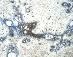 Glypican 3 was detected in immersion fixed paraffin-embedded sections of human breast using 5 &micro;g/mL Sheep Anti-Human Glypican 3 Antigen Affinity-purified Polyclonal Antibody (Catalog # AF2119) overnight at 4 &deg;C. Tissue was stained with the Anti-Sheep HRP-DAB Cell & Tissue Staining Kit (brown; Catalog # CTS019) and counterstained with hematoxylin (blue). View our protocol for Chromogenic IHC Staining of Paraffin-embedded Tissue Sections.