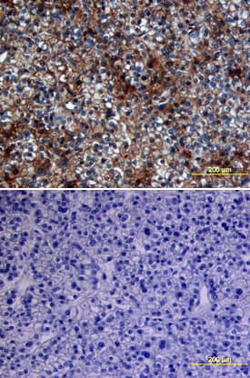 Glypican 3 was detected in immersion fixed paraffin-embedded sections of human liver cancer tissue using Sheep Anti-Human Glypican 3 Antigen Affinity-purified Polyclonal Antibody (Catalog # AF2119) at 10 µg/mL overnight at 4 °C. Tissue was stained using the Anti-Sheep HRP-DAB Cell & Tissue Staining Kit (brown; Catalog # CTS019) and counterstained with hematoxylin (blue). Lower panel shows a lack of labeling if primary antibodies are omitted and tissue is stained only with secondary antibody followed by incubation with detection reagents. View our protocol for Chromogenic IHC Staining of Paraffin-embedded Tissue Sections.