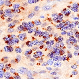 Golgi Glycoprotein 1/GLG1 was detected in immersion fixed paraffin-embedded sections of human astrocytoma using Sheep Anti-Human/Mouse/Rat Golgi Glycoprotein 1/GLG1 Antigen Affinity-purified Polyclonal Antibody (Catalog # AF7879) at 3 µg/mL for 1 hour at room temperature followed by incubation with the Anti-Sheep IgG VisUCyte™ HRP Polymer Antibody (Catalog # VC006). Before incubation with the primary antibody, tissue was subjected to heat-induced epitope retrieval using Antigen Retrieval Reagent-Basic (Catalog # CTS013). Tissue was stained using DAB (brown) and counterstained with hematoxylin (blue). Specific staining was localized to Golgi apparatus. View our protocol for IHC Staining with VisUCyte HRP Polymer Detection Reagents.