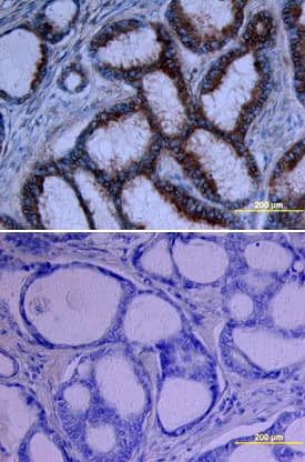 Growth Hormone R/GHR was detected in immersion fixed paraffin-embedded sections of human breast cancer tissue using Goat Anti-Human Growth Hormone R/GHR Biotinylated Antigen Affinity-purified Polyclonal Antibody (Catalog # BAF1210) at 15 µg/mL overnight at 4 °C. Tissue was stained using the Anti-Goat HRP-DAB Cell & Tissue Staining Kit (brown; Catalog # CTS008) and counterstained with hematoxylin (blue). Lower panel shows a lack of labeling if primary antibodies are omitted and tissue is stained only with secondary antibody followed by incubation with detection reagents. View our protocol for Chromogenic IHC Staining of Paraffin-embedded Tissue Sections.
