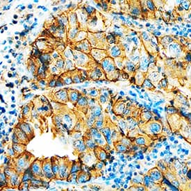 HAI-1 was detected in immersion fixed paraffin-embedded sections of human lung cancer tissue using Goat Anti-Human HAI-1 Antigen Affinity-purified Polyclonal Antibody (Catalog # AF1048) at 5 µg/mL overnight at 4 °C. Tissue was stained using the Anti-Goat HRP-DAB Cell & Tissue Staining Kit (brown; Catalog # CTS008) and counterstained with hematoxylin (blue). Specific staining was localized to plasma membrane in epithelial cells. View our protocol for Chromogenic IHC Staining of Paraffin-embedded Tissue Sections.