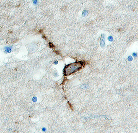 HAPLN4 was detected in immersion fixed paraffin-embedded sections of human brain (caudate nucleus) using 3 &micro;g/mL Goat Anti-Human HAPLN4 Antigen Affinity-purified Polyclonal Antibody (Catalog # AF4085) overnight at 4 &deg;C. Before incubation with the primary antibody tissue was subjected to heat-induced epitope retrieval using Antigen Retrieval Reagent-Basic (Catalog # CTS013). Tissue was stained with the Anti-Goat HRP-DAB Cell & Tissue Staining Kit (brown; Catalog # CTS008) and counterstained with hematoxylin (blue). View our protocol for Chromogenic IHC Staining of Paraffin-embedded Tissue Sections.