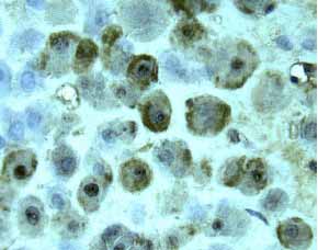 HB-EGF was detected in immersion fixed paraffin-embedded sections of human placenta using 15 &micro;g/mL Human HB-EGF Antigen Affinity-purified Polyclonal Antibody (Catalog # AF‑259‑NA) overnight at 4 &deg;C. Tissue was stained with the Anti-Goat HRP-DAB Cell & Tissue Staining Kit (brown; Catalog # CTS008) and counterstained with hematoxylin (blue). View our protocol for Chromogenic IHC Staining of Paraffin-embedded Tissue Sections.