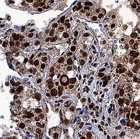 HES-1 was detected in immersion fixed paraffin-embedded sections of human liver cancer tissue using Mouse Anti-Human HES-1 Monoclonal Antibody (Catalog # MAB3317) at 5 µg/mL for 1 hour at room temperature followed by incubation with the Anti-Mouse IgG VisUCyte™ HRP Polymer Antibody (Catalog # VC001). Tissue was stained using DAB (brown) and counterstained with hematoxylin (blue). Specific staining was localized to nuclei. View our protocol for IHC Staining with VisUCyte HRP Polymer Detection Reagents.