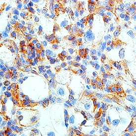 HGF R/c-MET was detected in immersion fixed paraffin-embedded sections of human renal cell carcinoma tissue using Rabbit Anti-Human/Mouse Phospho-HGF R/c-MET (Y1234/Y1235) Antigen Affinity-purified Polyclonal Antibody (Catalog # AF2480) at 15 µg/mL for 1 hour at room temperature followed by incubation with the Anti-Rabbit IgG VisUCyte™ HRP Polymer Antibody (Catalog # VC003). Before incubation with the primary antibody, tissue was subjected to heat-induced epitope retrieval using Antigen Retrieval Reagent-Basic (Catalog # CTS013). Tissue was stained using DAB (brown) and counterstained with hematoxylin (blue). Specific staining was localized to cytoplasm. View our protocol for IHC Staining with VisUCyte HRP Polymer Detection Reagents.
