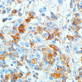 HGF R/c-MET was detected in immersion fixed paraffin-embedded sections of human renal cell carcinoma tissue using Rabbit Anti-Human/Mouse Phospho-HGF R/c-MET (Y1349) Antigen Affinity-purified Polyclonal Antibody (Catalog # AF3950) at 15 µg/mL for 1 hour at room temperature followed by incubation with the Anti-Rabbit IgG VisUCyte™ HRP Polymer Antibody (Catalog # VC003). Before incubation with the primary antibody, tissue was subjected to heat-induced epitope retrieval using Antigen Retrieval Reagent-Basic (Catalog # CTS013). Tissue was stained using DAB (brown) and counterstained with hematoxylin (blue). Specific staining was localized to cytoplasm. View our protocol for IHC Staining with VisUCyte HRP Polymer Detection Reagents.