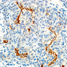 HGF R/c-MET was detected in immersion fixed paraffin-embedded sections of human renal cell carcinoma tissue using Mouse Anti-Human HGF R/c-MET Monoclonal Antibody (Catalog # MAB3581) at 15 µg/mL for 1 hour at room temperature followed by incubation with the Anti-Mouse IgG VisUCyte™ HRP Polymer Antibody (Catalog # VC001). Before incubation with the primary antibody, tissue was subjected to heat-induced epitope retrieval using Antigen Retrieval Reagent-Basic (Catalog # CTS013). Tissue was stained using DAB (brown) and counterstained with hematoxylin (blue). Specific staining was localized to plasma membrane. View our protocol for IHC Staining with VisUCyte HRP Polymer Detection Reagents.