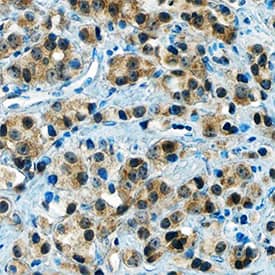 HIF-2a/EPAS1 was detected in immersion fixed paraffin-embedded sections of human prostate cancer tissue using Goat Anti-Human/Mouse/Rat HIF-2a/EPAS1 Antigen Affinity-purified Polyclonal Antibody (Catalog # AF2997) at 0.3 µg/mL overnight at 4 °C. Tissue was stained using the Anti-Goat HRP-DAB Cell & Tissue Staining Kit (brown; Catalog # CTS008) and counterstained with hematoxylin (blue). Specific staining was localized to cytoplasm and nuclei in cancer cells. View our protocol for Chromogenic IHC Staining of Paraffin-embedded Tissue Sections.