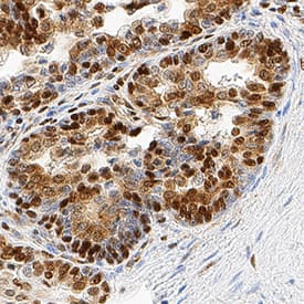 HMGB1/HMG-1 was detected in immersion fixed paraffin-embedded sections of human prostate cancer tissue using Rat Anti-Human/Mouse/Rat HMGB1/HMG-1 Monoclonal Antibody (Catalog # MAB16901) at 5 µg/mL overnight at 4 °C. Tissue was stained using the Anti-Rat HRP-DAB Cell & Tissue Staining Kit (brown; CTS017) and counterstained with hematoxylin (blue). Specific staining was localized to nuclei and cytoplasm. View our protocol for Chromogenic IHC Staining of Paraffin-embedded Tissue Sections.