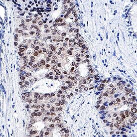HNF-3 beta /FoxA2 was detected in immersion fixed paraffin-embedded sections of human liver cancer tissue using Rabbit Anti-Human/Mouse/Rat HNF-3 beta /FoxA2 Monoclonal Antibody (Catalog # MAB2400) at 3 µg/mL for 1 hour at room temperature followed by incubation with the Anti-Rabbit IgG VisUCyte™ HRP Polymer Antibody (Catalog # VC003). Tissue was stained using DAB (brown) and counterstained with hematoxylin (blue). Specific staining was localized to nuclei. View our protocol for IHC Staining with VisUCyte HRP Polymer Detection Reagents.