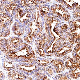 HSP27 was detected in immersion fixed paraffin-embedded sections of human ovarian cancer tissue using Rat Anti-Human HSP27 Monoclonal Antibody (Catalog # MAB15801) at 5 µg/mL overnight at 4 °C. Tissue was stained using the Anti-Rat HRP-DAB Cell & Tissue Staining Kit (brown; Catalog # <a class=