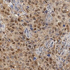 HSP70/HSPA1A was detected in immersion fixed paraffin-embedded sections of human kidney cancer tissue using Mouse Anti-Human/Mouse/Rat HSP70/HSPA1A Monoclonal Antibody (Catalog # MAB16631) at 5 µg/mL for 1 hour at room temperature followed by incubation with the Anti-Mouse IgG VisUCyte™ HRP Polymer Antibody (Catalog # VC001). Before incubation with the primary antibody, tissue was subjected to heat-induced epitope retrieval using Antigen Retrieval Reagent-Basic (Catalog # CTS013). Tissue was stained using DAB (brown) and counterstained with hematoxylin (blue). Specific staining was localized to cell nuclei. View our protocol for Chromogenic IHC Staining of Paraffin-embedded Tissue Sections.
