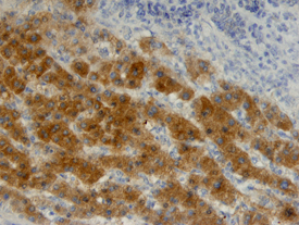 <b>Biological Strategies Validation. </b>HSP70/HSPA1A was detected in immersion fixed paraffin-embedded sections of human liver cancer tissue using Mouse Anti-Human/Mouse/Rat HSP70/HSPA1A Monoclonal Antibody (Catalog # MAB1663) at 25 µg/mL overnight at 4 °C. Tissue was stained using the Anti-Mouse HRP-DAB Cell & Tissue Staining Kit (brown; Catalog # CTS002) and counterstained with hematoxylin (blue). View our protocol for Chromogenic IHC Staining of Paraffin-embedded Tissue Sections.