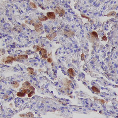 Herpesvirus Entry Mediator (HVEM/TNFRSF14) was detected in immersion fixed paraffin-embedded sections of human lung using Mouse Anti-Human HVEM/TNFRSF14 Monoclonal Antibody (Catalog # MAB3561) at 15 µg/mL for 1 hour at room temperature followed by incubation with the Anti-Mouse IgG VisUCyte™ HRP Polymer Antibody (Catalog # VC001). Tissue was stained using DAB (brown) and counterstained with hematoxylin (blue). Specific staining was localized to cytoplasm. View our protocol for IHC Staining with VisUCyte HRP Polymer Detection Reagents.