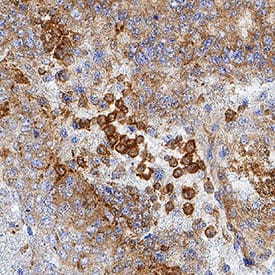IFN-epsilon was detected in immersion fixed paraffin-embedded sections of human endometrial cancer tissue using Mouse Anti-Human IFN-epsilon Monoclonal Antibody (Catalog # MAB9147) at 1 µg/mL for 1 hour at room temperature followed by incubation with the Anti-Mouse IgG VisUCyte™ HRP Polymer Antibody (Catalog # VC001). Tissue was stained using DAB (brown) and counterstained with hematoxylin (blue). Specific staining was localized to cancer cell cytoplasm. View our protocol for IHC Staining with VisUCyte HRP Polymer Detection Reagents.
