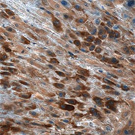 IGF-I/IGF-1 was detected in immersion fixed paraffin-embedded sections of human placenta using Goat Anti-Human IGF-I/IGF-1 Recombinant Monoclonal Antibody (Catalog # MAB2911) at 3 µg/mL overnight at 4 °C. Tissue was stained using the Anti-Goat HRP-DAB Cell & Tissue Staining Kit (brown; Catalog # CTS008) and counterstained with hematoxylin (blue). Specific staining was localized to cytoplasm in decidual cells. View our protocol for Chromogenic IHC Staining of Paraffin-embedded Tissue Sections.