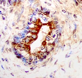 IL-13 Ra2 was detected in immersion fixed paraffin-embedded sections of human prostate cancer tissue using Goat Anti-Human IL-13 Ra2 Antigen Affinity-purified Polyclonal Antibody (Catalog # AF146) at 5 µg/mL overnight at 4 °C. Tissue was stained using the Anti-Goat HRP-DAB Cell & Tissue Staining Kit (brown; Catalog # CTS008) and counterstained with hematoxylin (blue). Specific staining was localized to glandular epithelial cells. View our protocol for Chromogenic IHC Staining of Paraffin-embedded Tissue Sections.