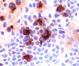 CD25/IL‑2 R alpha  was detected in immersion fixed frozen sections of human lymph node using 15 µg/mL Mouse Anti-Human CD25/IL‑2 R alpha  Monoclonal Antibody (Catalog # MAB623) overnight at 4 °C. Tissue was stained (red) and counterstained with hematoxylin (blue). View our protocol for Chromogenic IHC Staining of Frozen Tissue Sections.