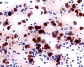 IL‑2 R beta  was detected in immersion fixed frozen sections of human lymph node using 15 &micro;g/mL Mouse Anti-Human IL‑2 R beta  Monoclonal Antibody (Catalog # MAB224) overnight at 4 &deg;C. Tissue was stained (red) and counterstained with hematoxylin (blue). View our protocol for Chromogenic IHC Staining of Frozen Tissue Sections.