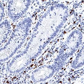 IL-17/IL-17A was detected in immersion fixed paraffin-embedded sections of human Crohn's disease intestine using Goat Anti-Human/Primate IL-17/IL-17A Biotinylated Antigen Affinity-purified Polyclonal Antibody (Catalog # BAF317) at 0.3 µg/mL for 1 hour at room temperature followed by incubation with the Anti-Goat IgG VisUCyte™ HRP Polymer Antibody (Catalog # VC004). Before incubation with the primary antibody, tissue was subjected to heat-induced epitope retrieval using Antigen Retrieval Reagent-Basic (Catalog # CTS013). Tissue was stained using DAB (brown) and counterstained with hematoxylin (blue). Specific staining was localized to lymphocytes. View our protocol for IHC Staining with VisUCyte HRP Polymer Detection Reagents.