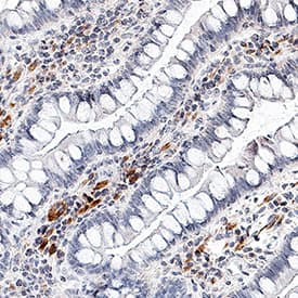 IL-17/IL-17A was detected in immersion fixed paraffin-embedded sections of human Crohn's disease intestine using Mouse Anti-Human IL-17/IL-17A Monoclonal Antibody (Catalog # MAB3171) at 0.5 µg/mL for 1 hour at room temperature followed by incubation with the Anti-Mouse IgG VisUCyte™ HRP Polymer Antibody (Catalog # VC001). Before incubation with the primary antibody, tissue was subjected to heat-induced epitope retrieval using Antigen Retrieval Reagent-Basic (Catalog # CTS013). Tissue was stained using DAB (brown) and counterstained with hematoxylin (blue). Specific staining was localized to lymphocytes. View our protocol for IHC Staining with VisUCyte HRP Polymer Detection Reagents.
