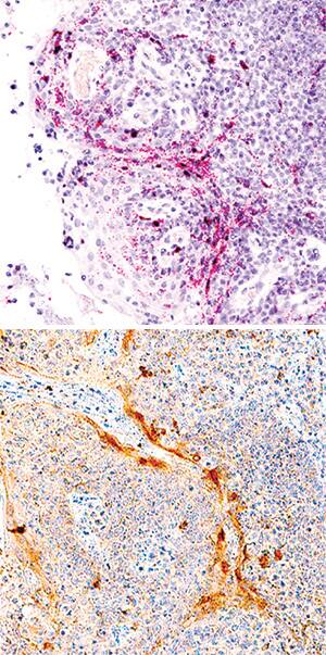 IL-1 beta /IL-1F2 mRNA was detected in formalin-fixed paraffin-embedded tissue sections of human tonsil probed with ACD RNAScope®Probe (Catalog # 310361) and stained using ACD RNAscope®2.5 HD Detection Reagents-Red (top image, Catalog # 32260). Adjacent tissue section was processed for immunohistochemistry using R&D Systems Goat Anti-Human IL-1 beta /IL-1F2 Antigen Affinity-purified Polyclonal Antibody (Catalog # AF-201-NA) at 1 ug/mL for 1 hour at room temperature followed by incubation with the Anti-Goat IgG VisUCyte HRP Polymer Antibody (R&D Systems, Catalog # VC004) and DAB chromogen (lower image, yellow-brown). Tissues were counterstained with hematoxylin (blue).