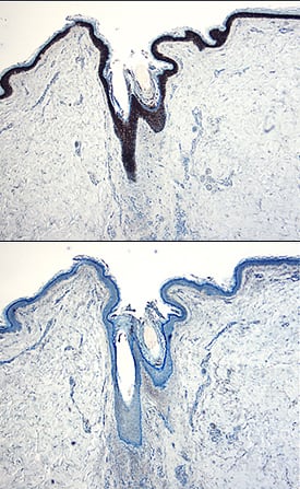 IL-1ra/IL-1F3 was detected in immersion fixed paraffin-embedded sections of human skin using Goat Anti-Human IL-1ra/IL-1F3 Antigen Affinity-purified Polyclonal Antibody (Catalog # AF-280-NA) at 5 µg/mL overnight at 4 °C. Tissue was stained using the Anti-Goat HRP-DAB Cell & Tissue Staining Kit (brown; Catalog # CTS008) and counterstained with hematoxylin (blue). Specific staining was localized to keratinocytes. View our protocol for Chromogenic IHC Staining of Paraffin-embedded Tissue Sections.