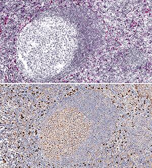 <b>Orthogonal Strategies Validation. </b>IL-33 mRNA was detected in formalin-fixed paraffin-embedded tissue sections of human tonsil probed with ACD RNAScope®Probe (Catalog # 400111) and stained using ACD RNAscope®2.5 HD Detection Reagents-Red (top image, Catalog # 32260). Adjacent tissue section was processed for immunohistochemistry using R&D Systems Goat Anti-Human IL-33 Antigen Affinity-purified Polyclonal Antibody (Catalog # AF3625) at 3 ug/mL with overnight incubation at 4 °C followed by incubation with the Anti-Goat IgG VisUCyte HRP Polymer Antibody (R&D Systems, Catalog # VC004) and DAB chromogen (lower image, yellow-brown). Tissues were counterstained with hematoxylin (blue).