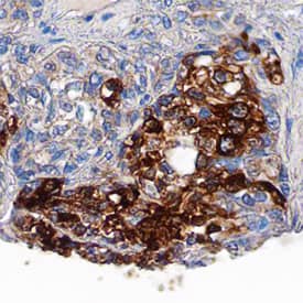IRS1 was detected in immersion fixed paraffin-embedded sections of human liver cancer tissue using Goat Anti-Human/Mouse/Rat IRS1 Antigen Affinity-purified Polyclonal Antibody (Catalog # AF3978) at 15 µg/mL overnight at 4 °C. Tissue was stained using the Anti-Goat HRP-DAB Cell & Tissue Staining Kit (brown; Catalog # CTS008) and counterstained with hematoxylin (blue). Specific staining was localized to cytoplasm. View our protocol for Chromogenic IHC Staining of Paraffin-embedded Tissue Sections.