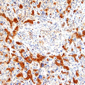 Alkaline Phosphatase was detected in paraffin-embedded sections of human liver cancer using Mouse Anti-Human Alkaline Phosphatase/ALPL Monoclonal Antibody (Catalog # MAB1448) at 1 µg/mL for 1 hour at room temperature followed by incubation for 30 minutes at room temperature with Anti-Mouse IgG VisUCyte HRP Polymer Antibody (Catalog # VC001). Tissue was stained with DAB (brown color) and counterstained with hematoxylin (blue color).