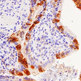 HAI-1 was detected in paraffin-embedded sections of human lung cancer using Goat Anti-Human HAI-1 Ectodomain Antigen Affinity-purified Polyclonal Antibody (Catalog # AF1048) at 1 µg/mL for 1 hour at room temperature followed by incubation for 30 minutes at room temperature with Anti-Goat IgG VisUCyte HRP Polymer Antibody (Catalog # VC004). Tissue was stained with DAB (brown color) and counterstained with hematoxylin (blue color).