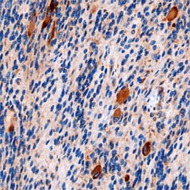IkB-e was detected in immersion fixed paraffin-embedded sections of human astrocytoma using Goat Anti-Human IkB-e Antigen Affinity-purified Polyclonal Antibody (Catalog # AF4300) at 3 µg/mL overnight at 4 °C. Before incubation with the primary antibody, tissue was subjected to heat-induced epitope retrieval using Antigen Retrieval Reagent-Basic (Catalog # CTS013). Tissue was stained using the Anti-Goat HRP-DAB Cell & Tissue Staining Kit (brown; Catalog # CTS008) and counterstained with hematoxylin (blue). Specific staining was localized to cytoplasm of neurons. View our protocol for Chromogenic IHC Staining of Paraffin-embedded Tissue Sections.