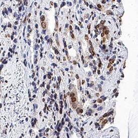 IkB-a was detected in immersion fixed paraffin-embedded sections of human prostate cancer tissue using Mouse Anti-Human IkB-a Monoclonal Antibody (Catalog # MAB4299) at 5 µg/mL for 1 hour at room temperature followed by incubation with the Anti-Mouse IgG VisUCyte™ HRP Polymer Antibody (Catalog # VC001). Tissue was stained using DAB (brown) and counterstained with hematoxylin (blue). Specific staining was localized to cytoplasm and nuclei in cancer cells. View our protocol for IHC Staining with VisUCyte HRP Polymer Detection Reagents.