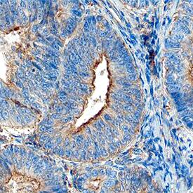 JAM-A was detected in immersion fixed paraffin-embedded sections of human endometrial cancer tissue using Human JAM-A Monoclonal Antibody (Catalog # MAB1103) at 15 µg/mL overnight at 4 °C. Before incubation with the primary antibody, tissue was subjected to heat-induced epitope retrieval using Antigen Retrieval Reagent-Basic (Catalog # CTS013). Tissue was stained using the Anti-Mouse HRP-DAB Cell & Tissue Staining Kit (brown; Catalog # CTS002) and counterstained with hematoxylin (blue). Specific staining was localized to the plasma membrane of glandular epithelial cells. View our protocol for Chromogenic IHC Staining of Paraffin-embedded Tissue Sections.