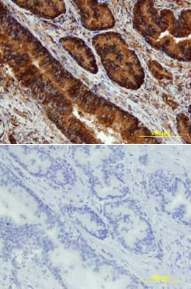 JNK phosphorylated at T183/Y185 was detected in immersion fixed paraffin-embedded sections of human prostate array using Rabbit Anti-Human/Mouse/Rat Phospho-JNK (T183/Y185) Antigen Affinity-purified Polyclonal Antibody (Catalog # AF1205) at 15 µg/mL overnight at 4 °C. Tissue was stained using the Anti-Rabbit HRP-DAB Cell & Tissue Staining Kit (brown; Catalog # CTS005) and counterstained with hematoxylin (blue). Lower panel shows a lack of labeling if primary antibodies are omitted and tissue is stained only with secondary antibody followed by incubation with detection reagents. View our protocol for Chromogenic IHC Staining of Paraffin-embedded Tissue Sections.